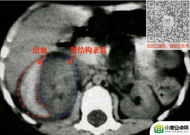 手机教你一招秒懂视频 CT阅片速成方法