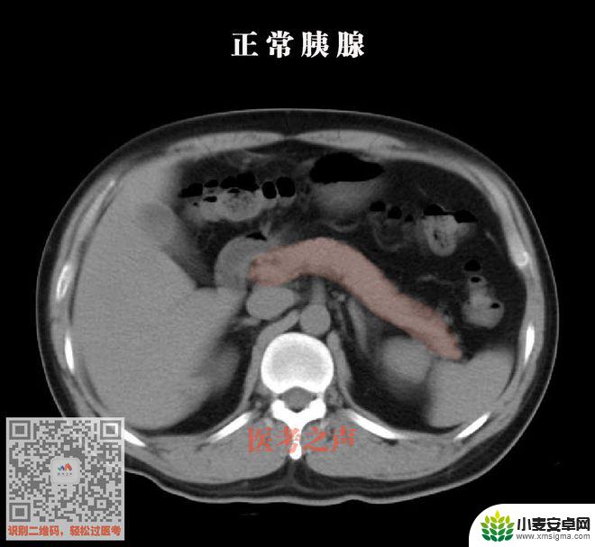 手机教你一招秒懂视频 CT阅片速成方法