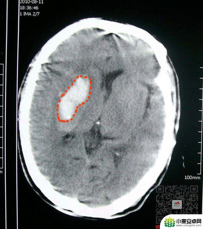 手机教你一招秒懂视频 CT阅片速成方法