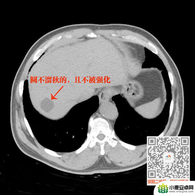 手机教你一招秒懂视频 CT阅片速成方法