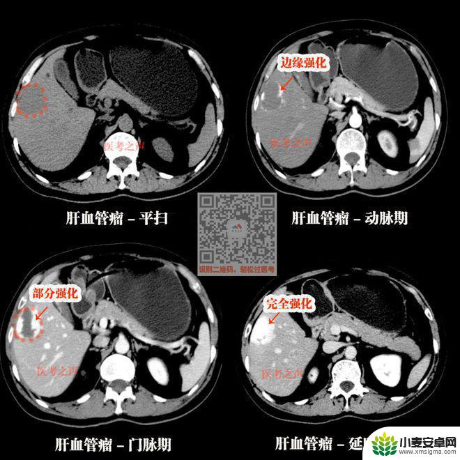 手机教你一招秒懂视频 CT阅片速成方法
