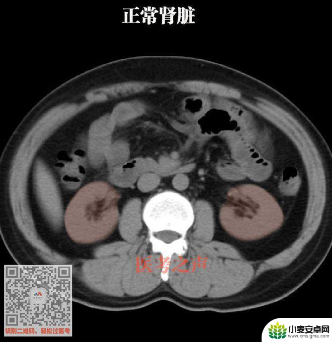 手机教你一招秒懂视频 CT阅片速成方法
