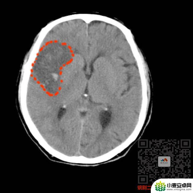 手机教你一招秒懂视频 CT阅片速成方法