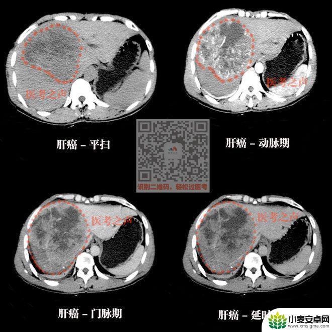 手机教你一招秒懂视频 CT阅片速成方法