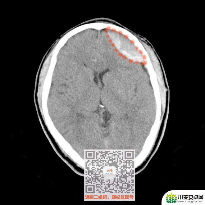 手机教你一招秒懂视频 CT阅片速成方法