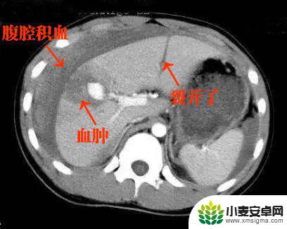 手机教你一招秒懂视频 CT阅片速成方法