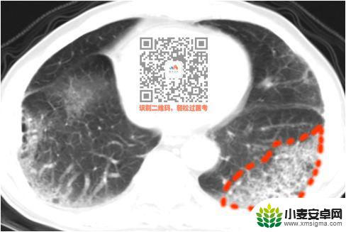 手机教你一招秒懂视频 CT阅片速成方法