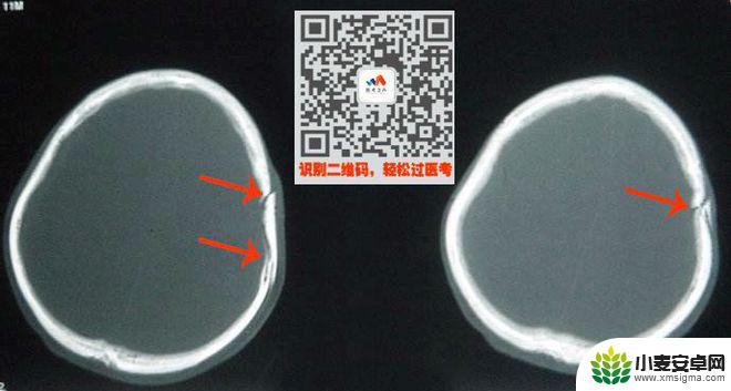 手机教你一招秒懂视频 CT阅片速成方法