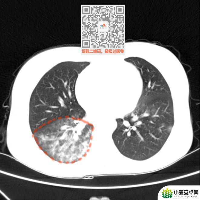手机教你一招秒懂视频 CT阅片速成方法